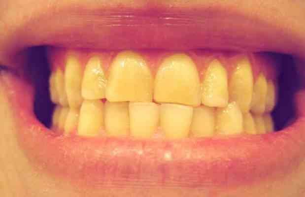 الأسنان الصفراء:
