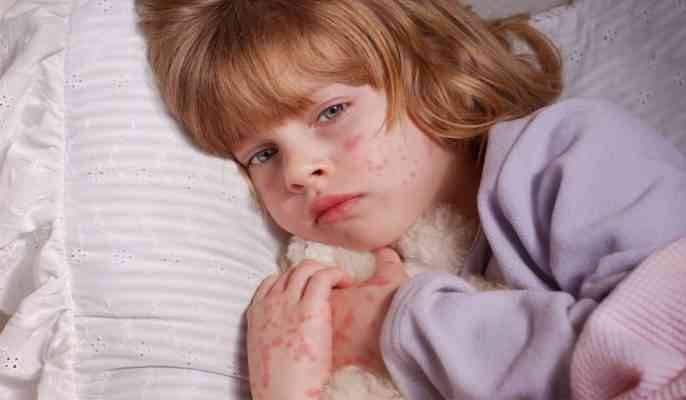  طفح جلد وحساسية عند الأطفال - أضرار سابوفين للأطفال