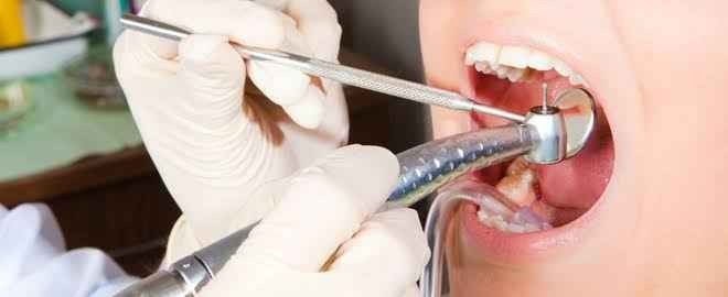 علاج تسوس الأسنان .. كيف أتخلص من التسوس