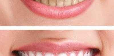 علاج إصفرار الاسنان من خلال بيكربونات الصوديوم  - استخدامات بيكربونات الصوديوم للاسنان