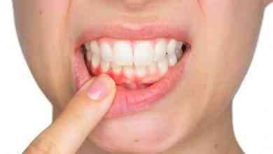 علاج التهاب اللثة والاسنان