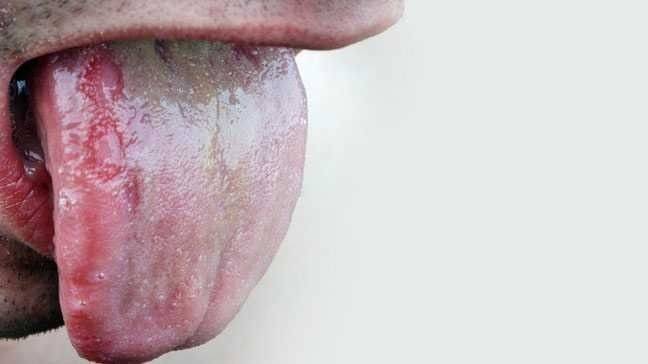  كيفية علاج فطريات الفم