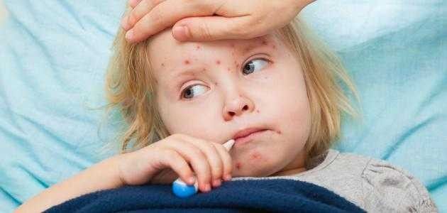 أعراض الحصبه عند الأطفال  - الحصبة عند الاطفال