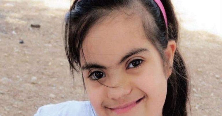 أنواع متلازمة داون