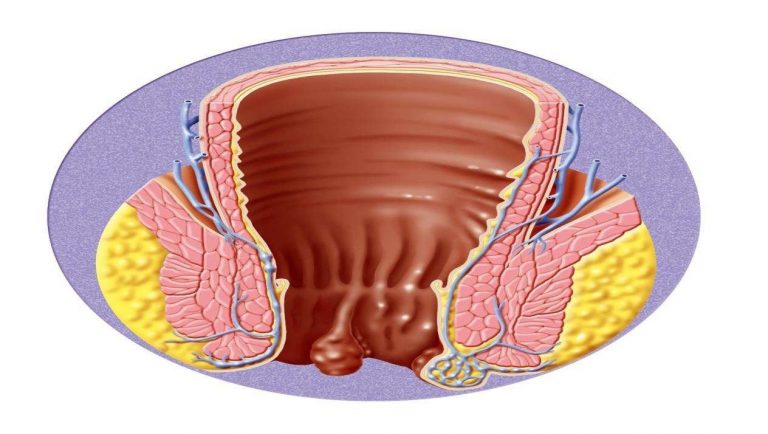 اعراض البواسير