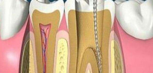 ماهو علاج الم الاسنان