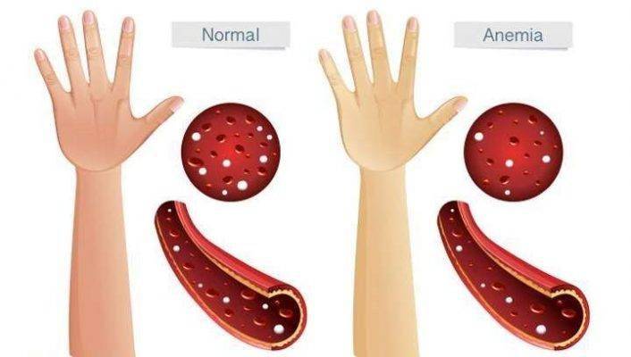أسباب فقر الدم .. تعرف عليها ..