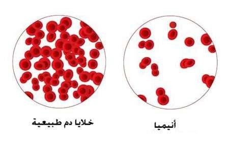 هل تعلم عن الانيميا .. معلومات أكثر عن الانيميا