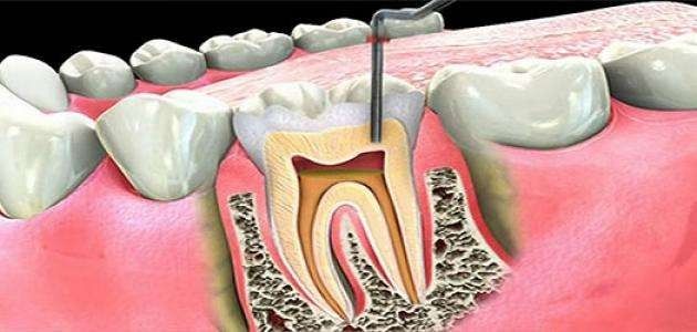 ماهو علاج الم الاسنان