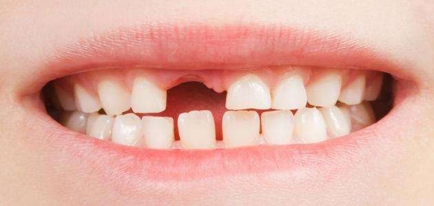 كم عدد الأسنان اللبنية