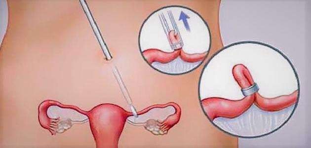 أين توجد قناة فالوب تعرف على مكان تواجدها ووظيفتها والشكل التشريحي لها