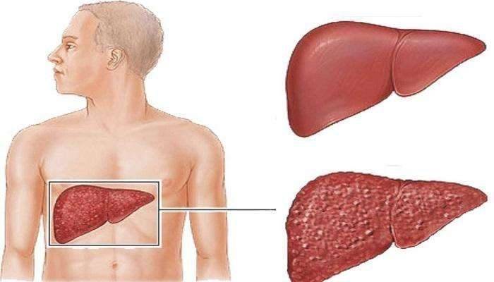 أمراض الكبد لها أسباب كثيرة ..