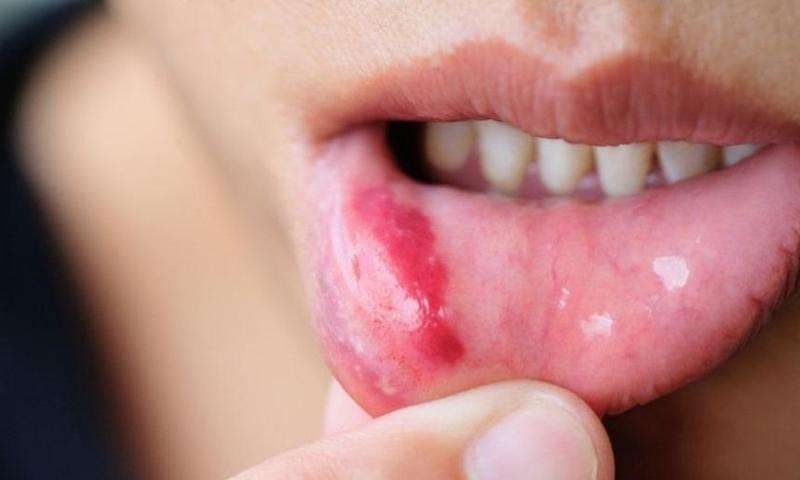 اسباب سرطان الفم