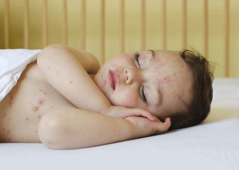 علاج حساسية المضادات الحيوية عند الاطفال