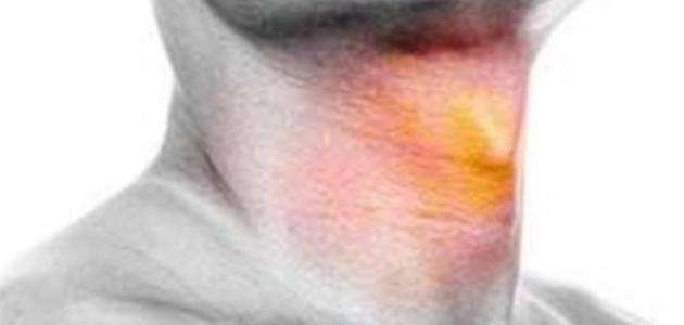 عوامل الخطر لسرطان الحلق