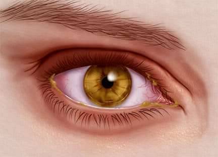 كيفية الوقاية من التهابات العين