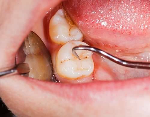 أعراض خراج الأسنان