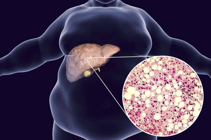 أعراض الكبد الدهني او دهون الكبد
