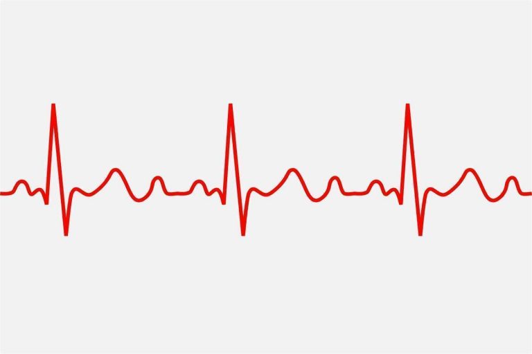 أعراض وعلامات عدم انتظام ضربات القلب