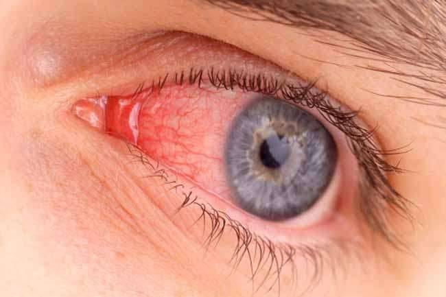 أعراض فيروس العين