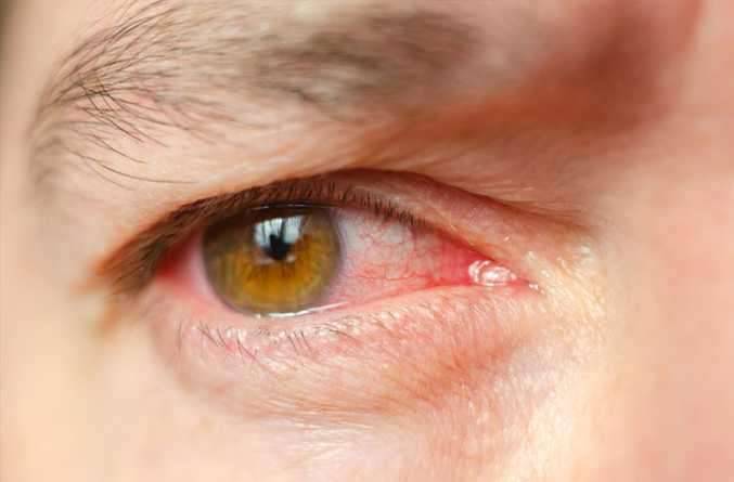 العين الوردية، أو التهاب الملتحمة
