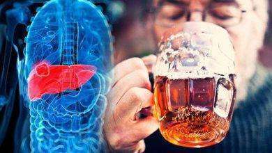 مرض الكبد الكحولي