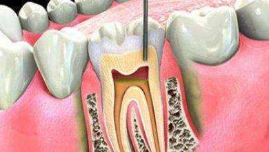 أعراض عصب الأسنان