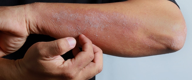 الحماية من التهابات الجلد