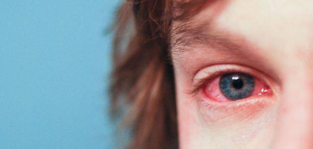 قطرة عين بريمونوكوند Brimonocond لعلاج ارتفاع ضغط العين
