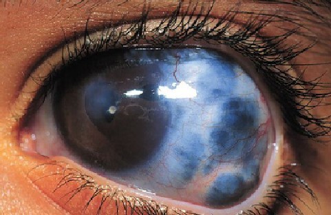 قطرة تيمولول Timolol لعلاج جلوكوما العين