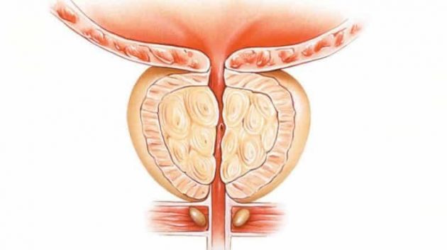 كبسولات بروسنورم Prosnorm لعلاج تضخم البروستاتا 