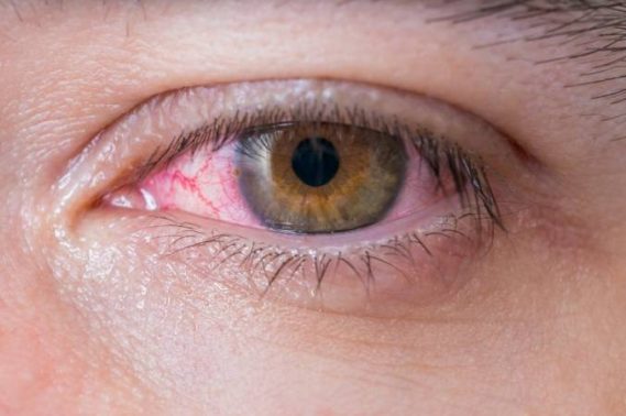 قطرة عين بريدمايسين بي Predmycin-p لعلاج التهاب العينين