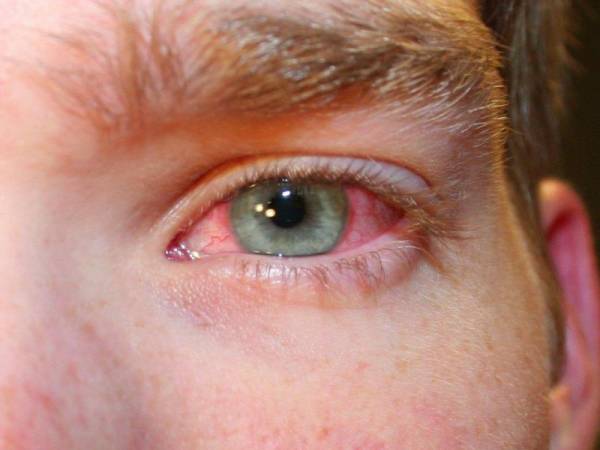 أوبتيلاكس OPTILAX علاج ضغط العين