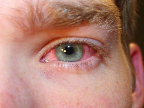 ترافوبروست Travoprost علاج ارتفاع ضغط العين