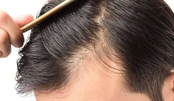 المينوكسيديل Minoxidil لعلاج تساقط الشعر