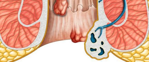 سيديبروكت Sediproct لعلاج ألام وتورمات البواسير