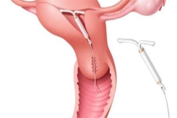 اللولب النحاسي Copper IUD لتحديد النسل