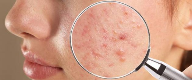 أكني بيوتك Acne Biotic محلول لعلاج حب الشباب  