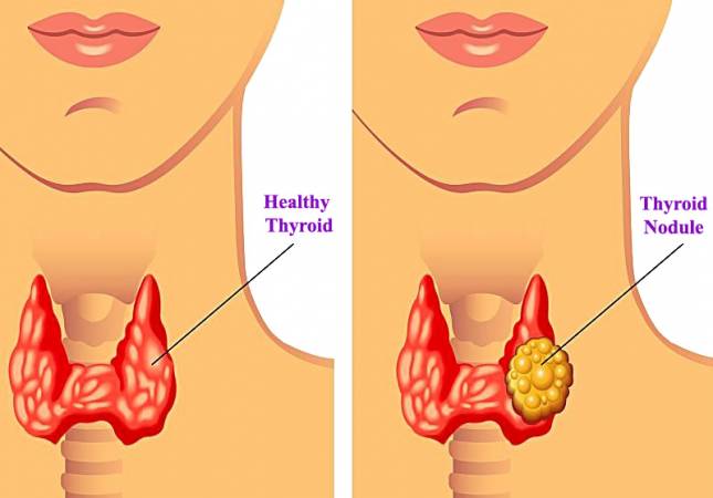 تجربتي مع عقد الغدة الدرقية