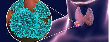 تجربتي مع عقد الغدة الدرقية