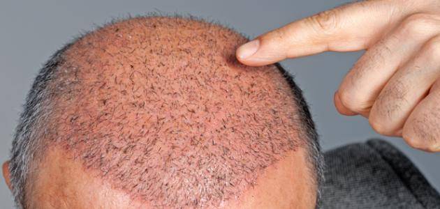 زراعة الشعر في الرياض