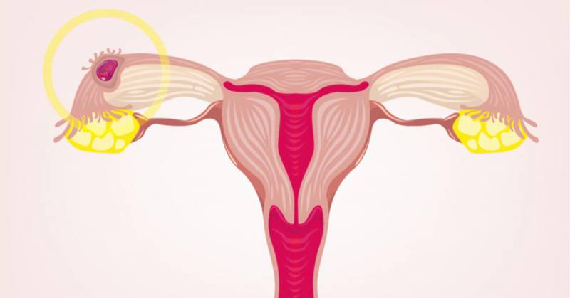 أعراض الحمل خارج الرحم
