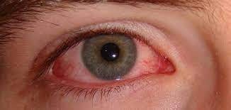 علاج احمرار العين2