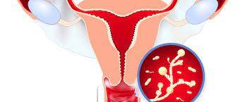 كل ما تحتاجين لمعرفته حول التهابات المهبل 1 كل ما تحتاجين لمعرفته حول التهابات المهبل 1