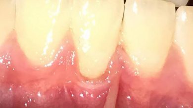 أسباب صرير الأسنان وعلاماته وكيفية علاجه1