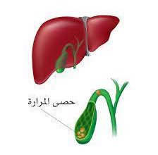 ما-علاج-حصى-المرارة