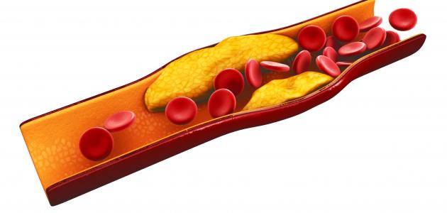 أعراض ارتفاع نسبة الدهون في الدم