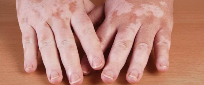 اسباب البهاق