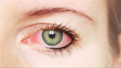 علاج حساسية العين واحمرارها في المنزل