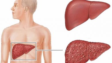ما هي غيبوبة الكبد